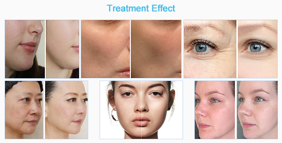 Máscara facial antienvelhecimento da máquina Máscara facial antienvelhecimento da máquina