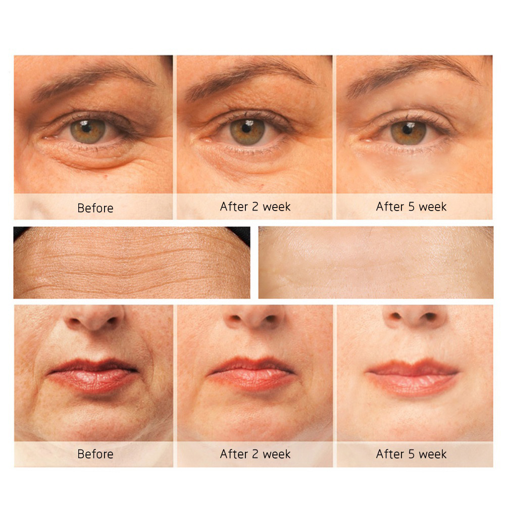 Purificador ultra-sônico da pele Purificador ultra-sônico da pele