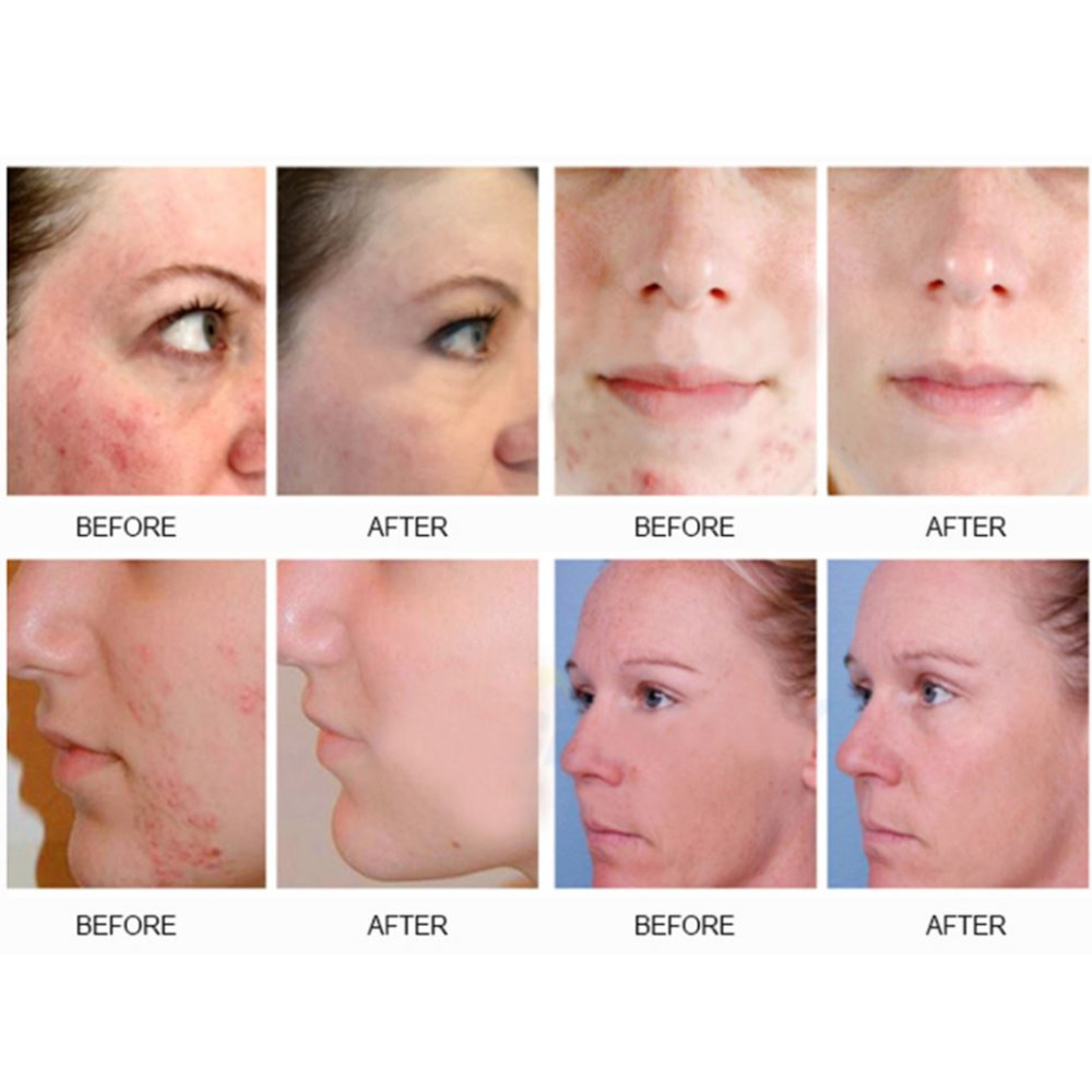 Venda direta 7 cores pdt led terapia fotodinâmica